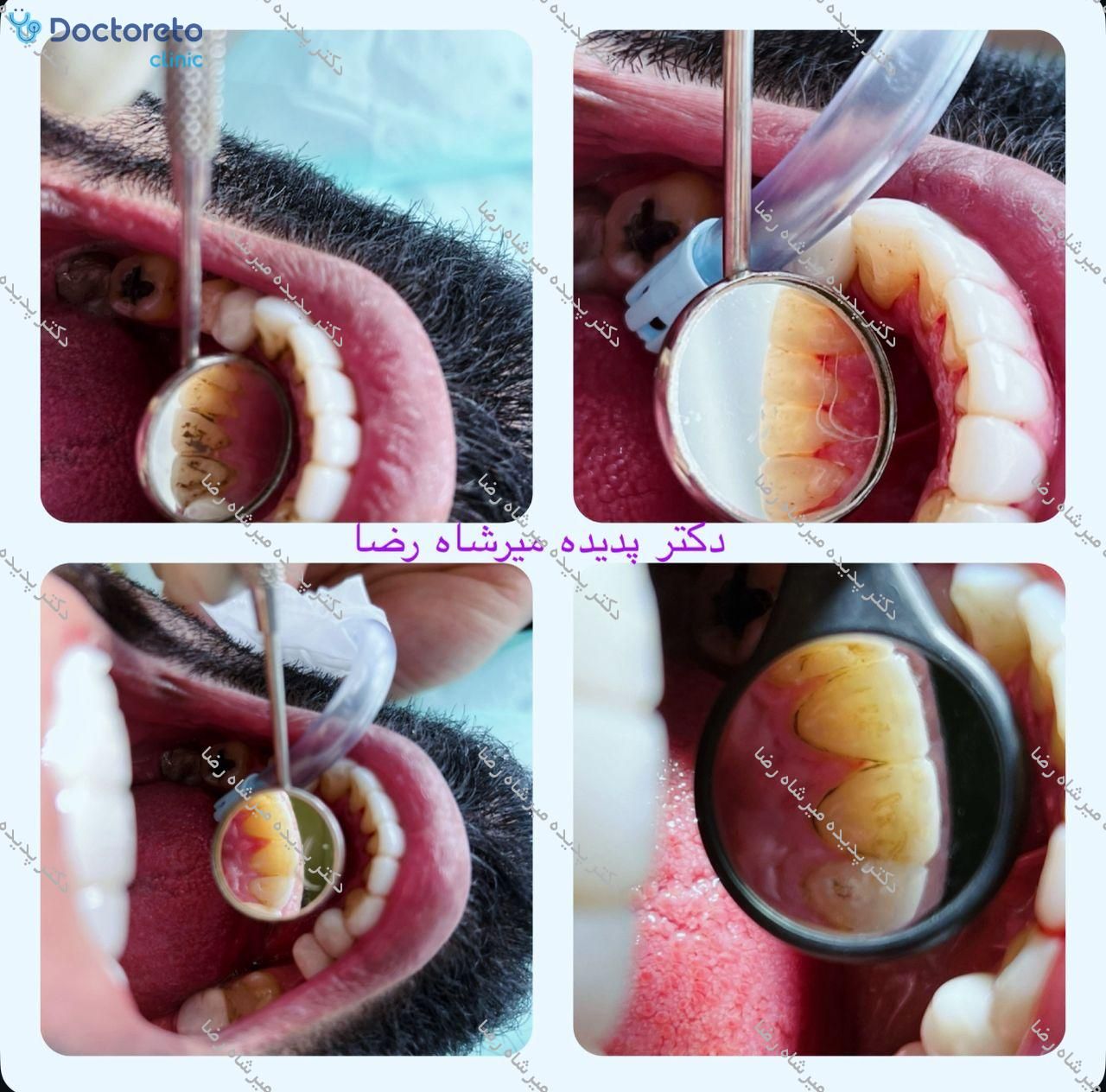 جرم گیری کامل دندان‌های دو فک با بروساژ🦷