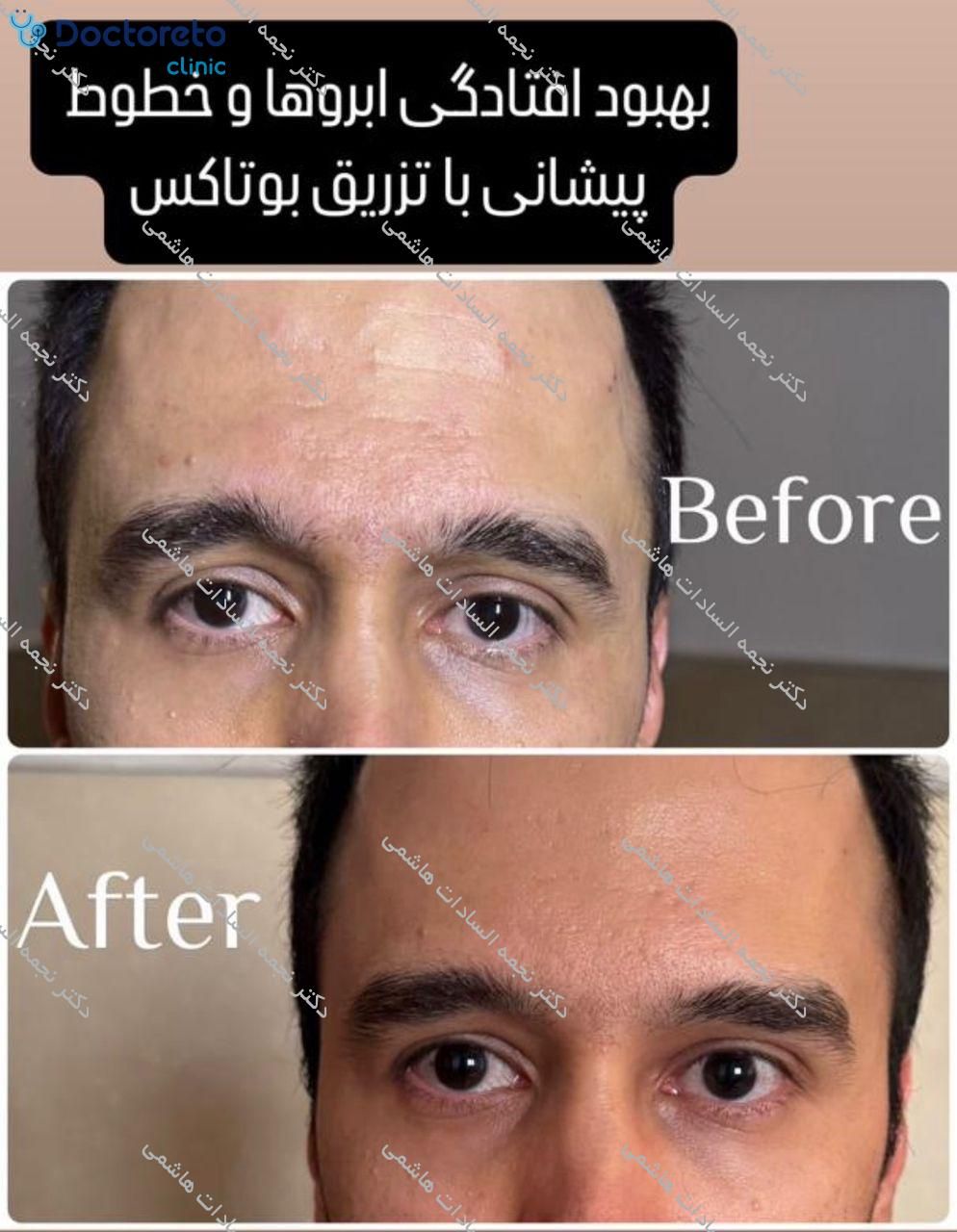 تزریق بوتاکس صورت (پیشانی، خط اخم، پنجه کلاغی)💉