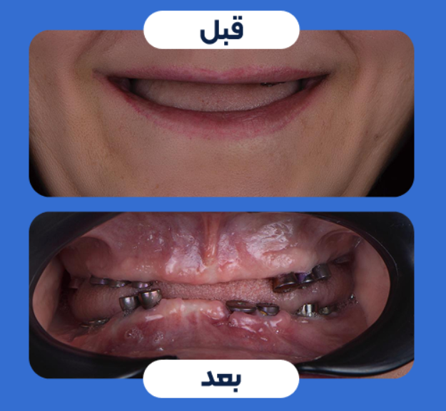 ونیر کامپوزیت دندان (هر واحد)