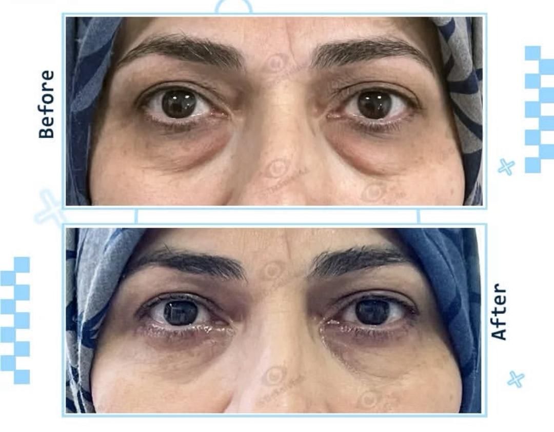 بلفاروپلاستی پلک‌های پایین به روش داخلی