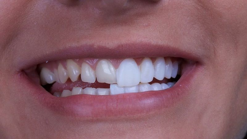 لمینت دندان (هر واحد)