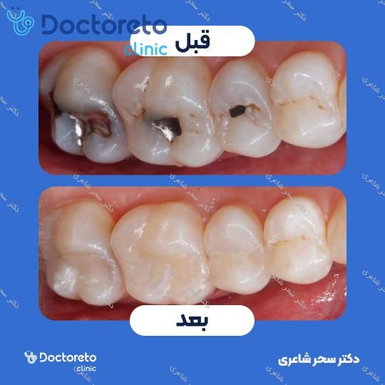 پرکردن دندان