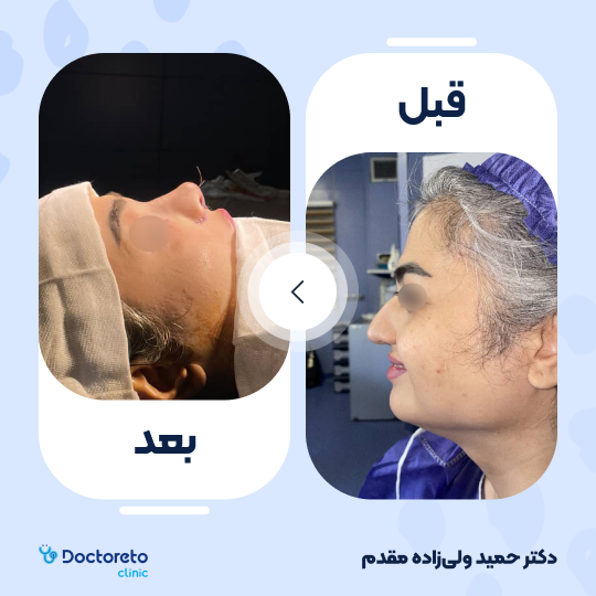 عمل زیبایی بینی گوشتی(رینوپلاستی)