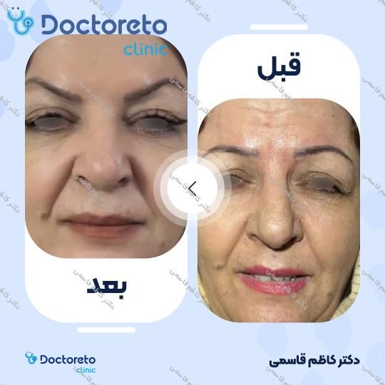 تزریق بوتاکس صورت (پیشانی، خط اخم، پنجه کلاغی)💉