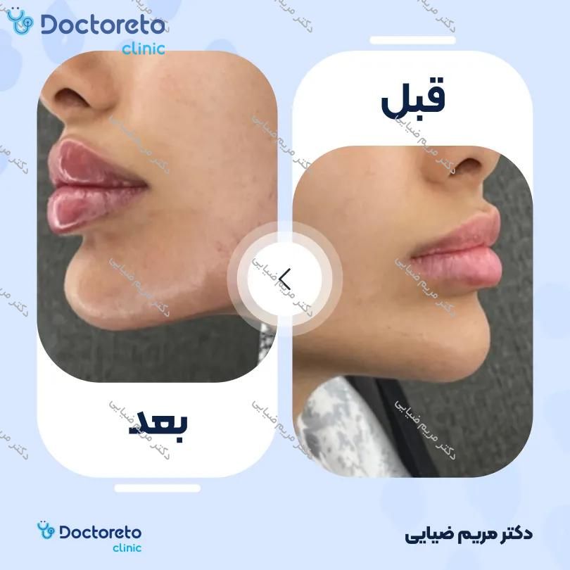 تزریق ژل لب