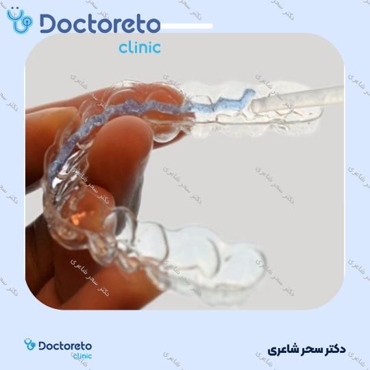 بلیچینگ دندان (سفید کردن دندان)