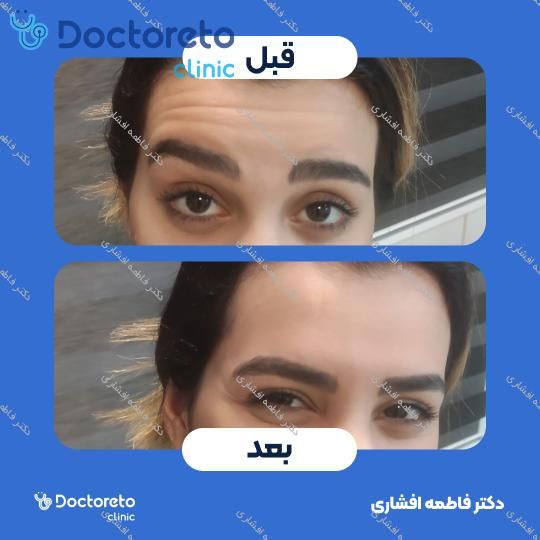 تزریق بوتاکس صورت (پیشانی، خط اخم، پنجه کلاغی)💉
