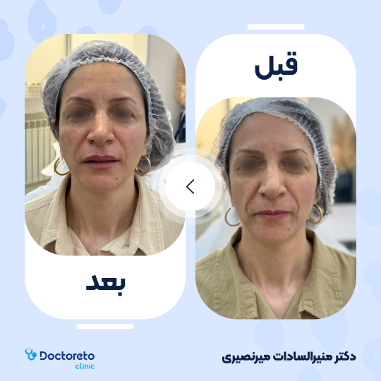 تزریق ژل زیرچشم