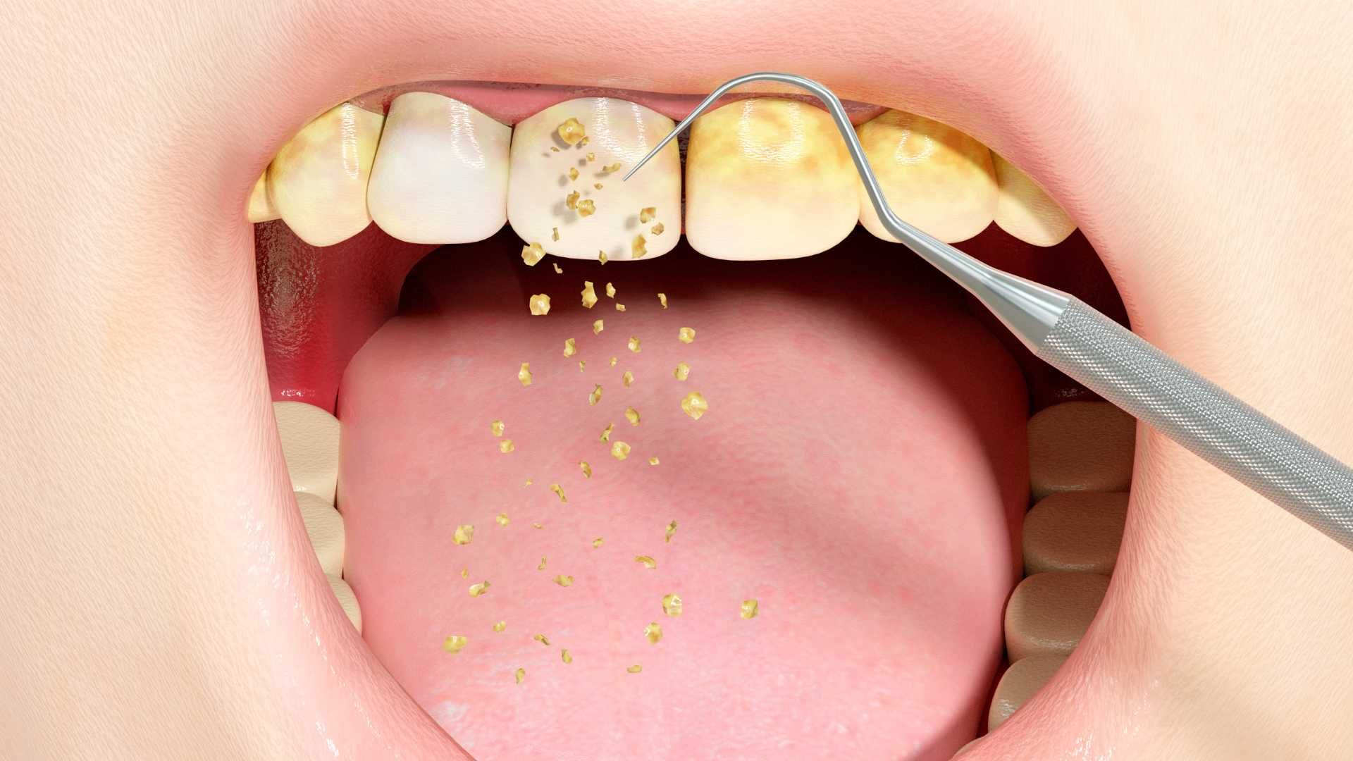 جرم گیری کامل دندان‌های دو فک با بروساژ
