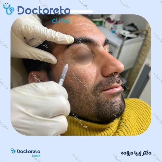 تزریق بوتاکس صورت (پیشانی، خط اخم، پنجه کلاغی)💉