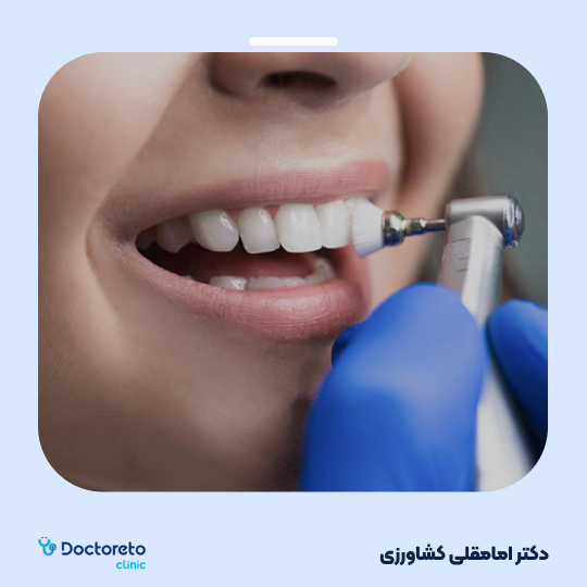 جرم گیری کامل دندان‌های دو فک با بروساژ🦷