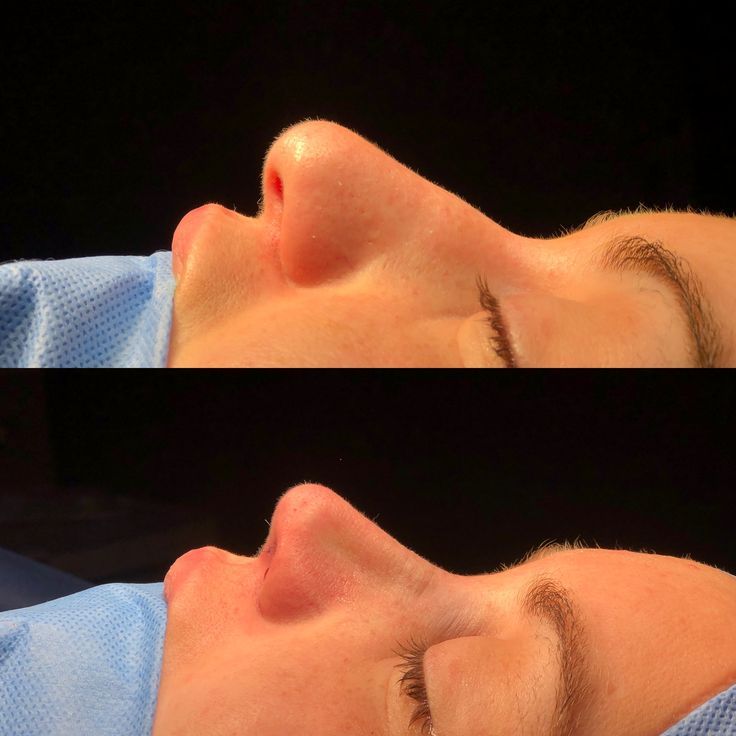 جراحی انحراف بینی (سپتوپلاستی)