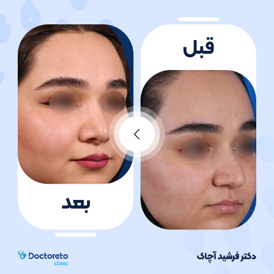 عمل زیبایی بینی گوشتی (رینوپلاستی)