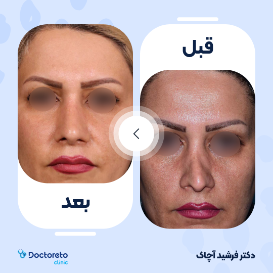 عمل جراحی ترمیمی زیبایی بینی (رینوپلاستی)