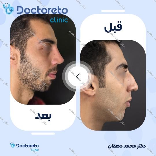 عمل جراحی مجدد بینی (رینوپلاستی)