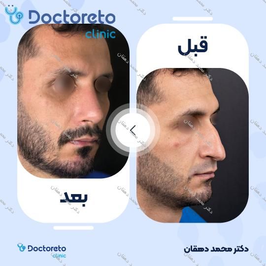 عمل جراحی مجدد بینی (رینوپلاستی)