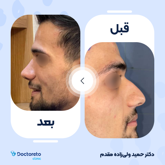 عمل زیبایی بینی استخوانی (رینوپلاستی)