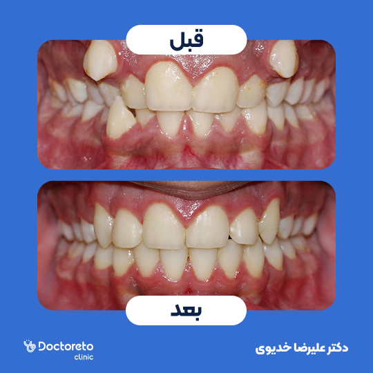 ارتودنسی ثابت فلزی