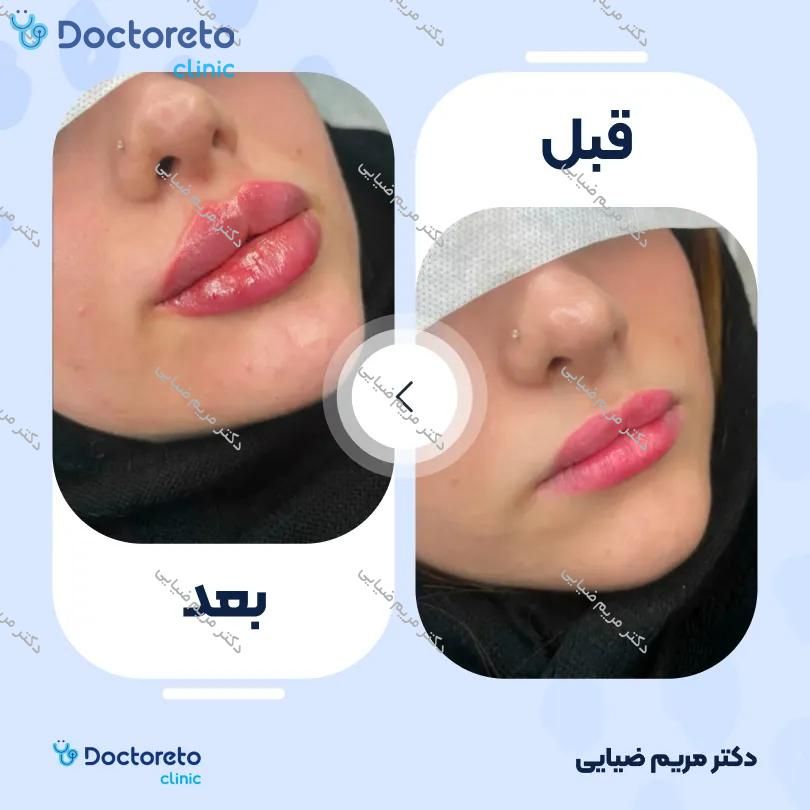 تزریق ژل لب