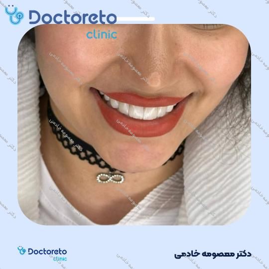 لمینت دندان (هر واحد)