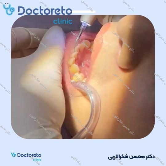 جرم گیری کامل دندان‌های دو فک با بروساژ