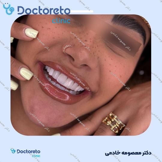 لمینت دندان (هر واحد)