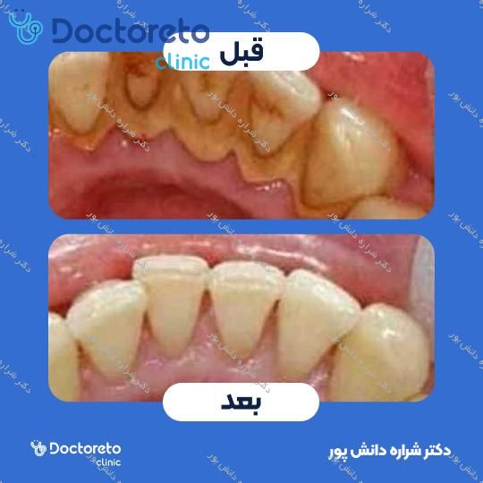 جرم گیری کامل دندان‌های دو فک با بروساژ