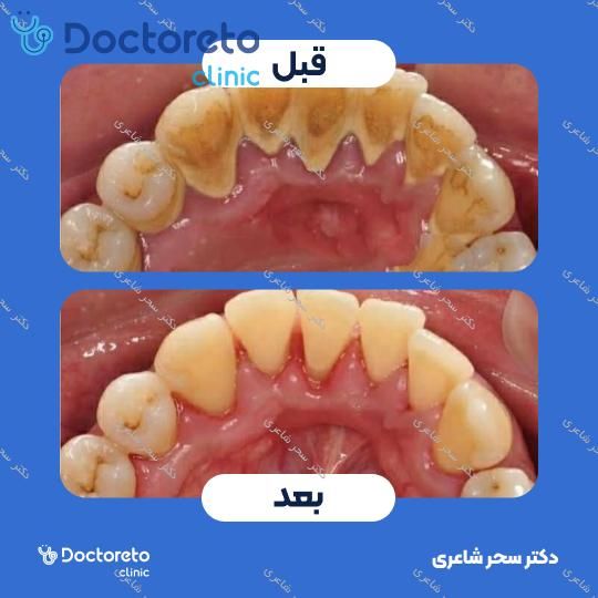 جرم گیری دو فک با بروساژ 🪻 دکتر سحر شاعری در تهران 1