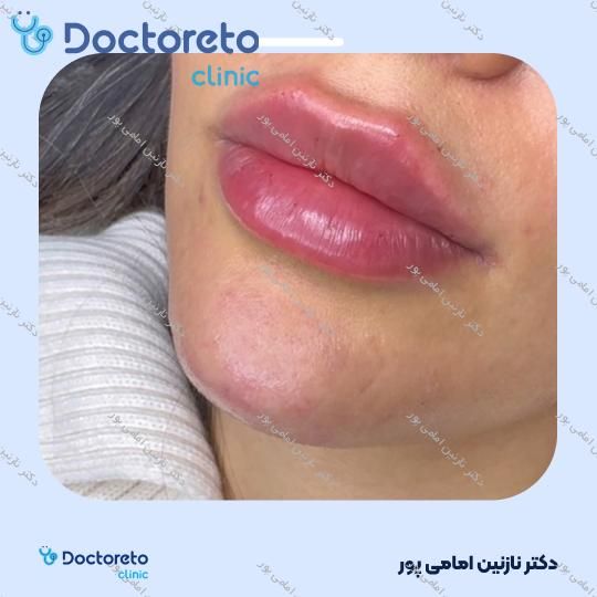 تزریق ژل لب با برند فیوریج ( هر سی سی )