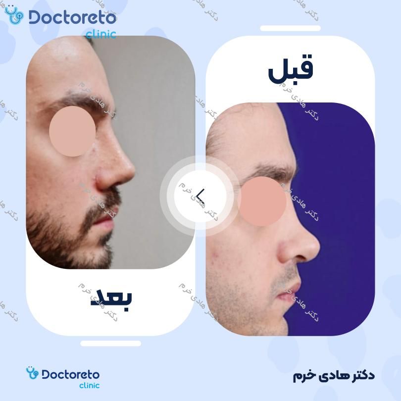 عمل جراحی مجدد زیبایی بینی (رینوپلاستی) دکتر هادی خرم در تهران 2