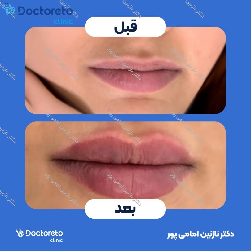 تزریق ژل لب با برند فیوریج ( هر سی سی )