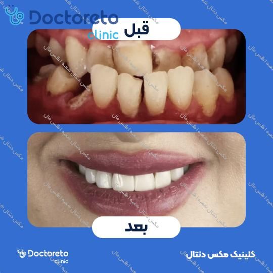 ارتودنسی ثابت (دو فک) مکس دنتال شعبه اطلس مال در تهران 19