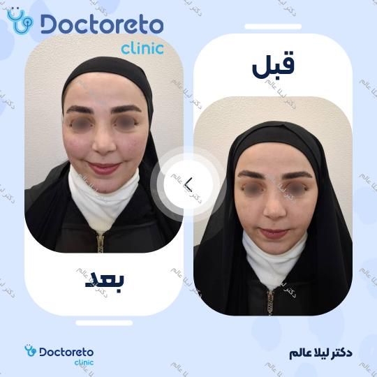 تزریق ژل گونه با برند رووفیل (1CC) دکتر لیلا عالم در اصفهان 2