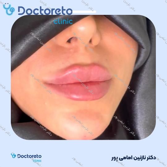 تزریق ژل لب با برند نیوویا ( هر سی سی )