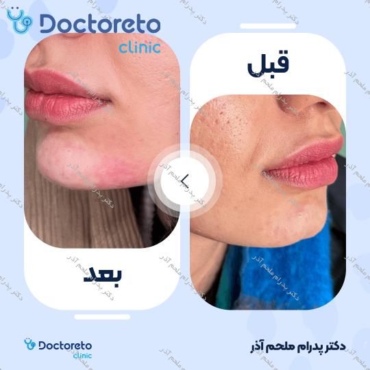 تزریق ژل چانه با برند فیورج (1cc)