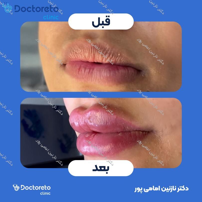 تزریق ژل لب با برند استایلج ( هر سی سی )