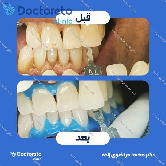 آفیس بلیچینگ (سفید کردن دندان) دو فک با مواد آلمانی Power Whitening