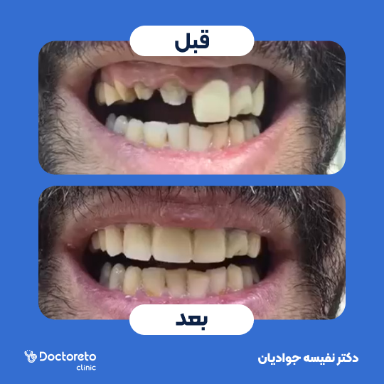 روکش تمام سرامیک زیرکونیا (هر واحد)