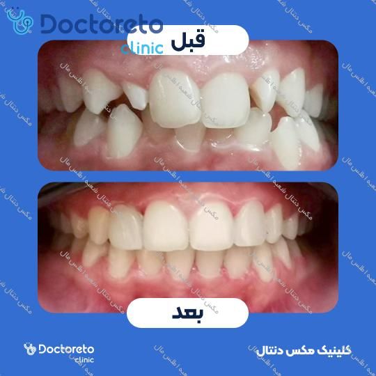 ارتودنسی متحرک (یک فک) مکس دنتال شعبه اطلس مال در تهران 24