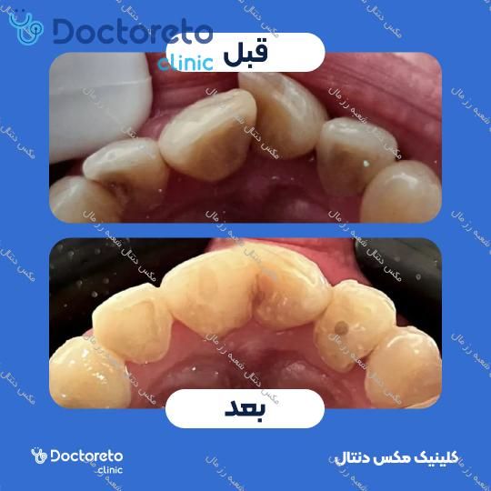 ارتودنسی متحرک (یک فک) مکس دنتال شعبه رز مال در تهران 15