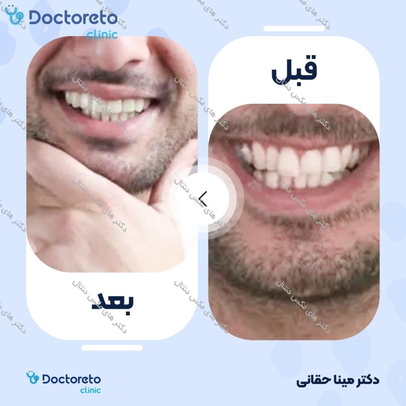 ارتودنسی ثابت (یک فک) دکتر های مکس دنتال در تهران 17