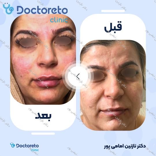 تزریق ژل گونه با برند نیوویا ( هر سی سی ) دکتر نازنین امامی پور در تهران 10