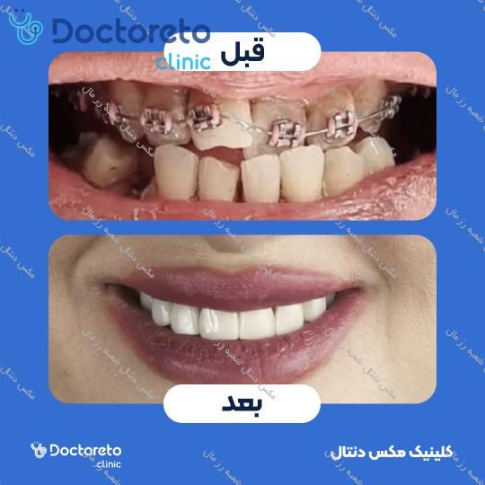 ارتودنسی ثابت (دو فک) مکس دنتال شعبه رز مال در تهران 22