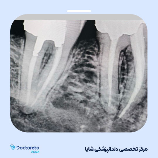 عصب کشی 3 کانال مرکز تخصصی شایا شیراز در شیراز 7