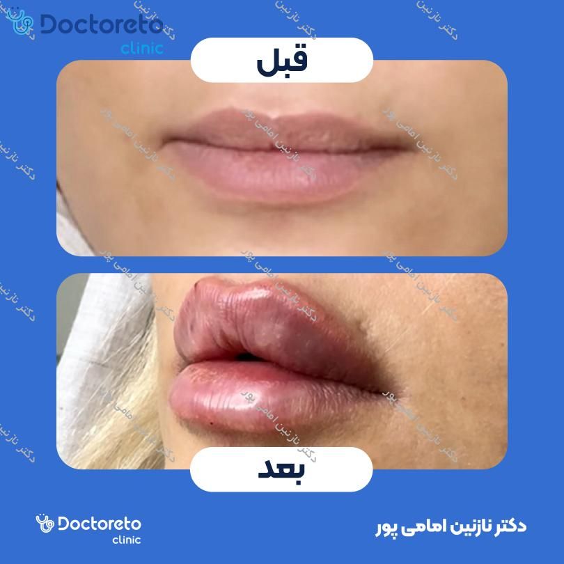 تزریق ژل لب با برند فیوریج ( هر سی سی )