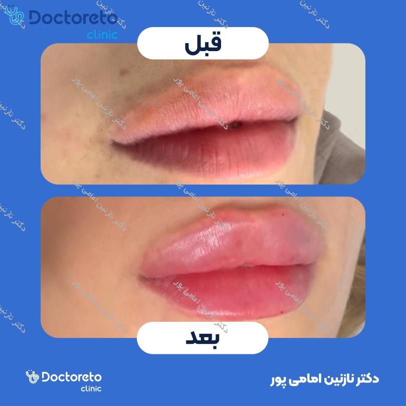 تزریق ژل لب با برند فیوریج ( هر سی سی )