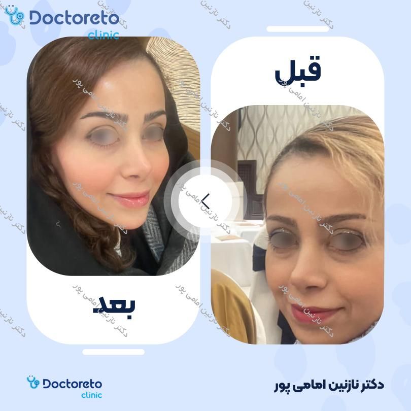 تزریق ژل گونه با برند نیوویا ( هر سی سی ) دکتر نازنین امامی پور در تهران 9