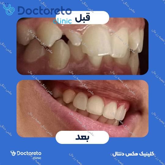 ارتودنسی ثابت (یک فک) مکس دنتال شعبه رز مال در تهران 16