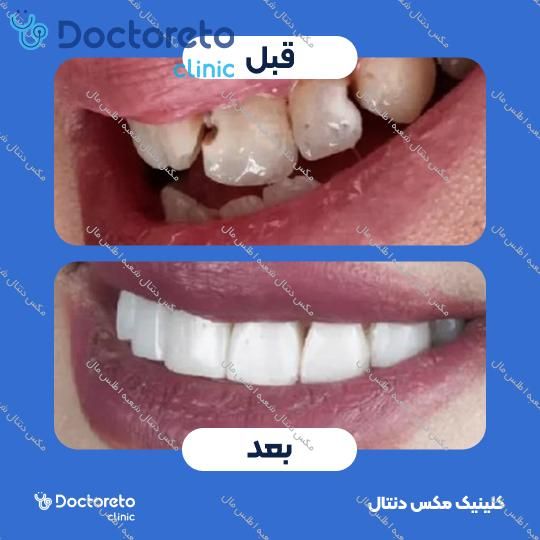 ارتودنسی متحرک (دو فک) مکس دنتال شعبه اطلس مال در تهران 14