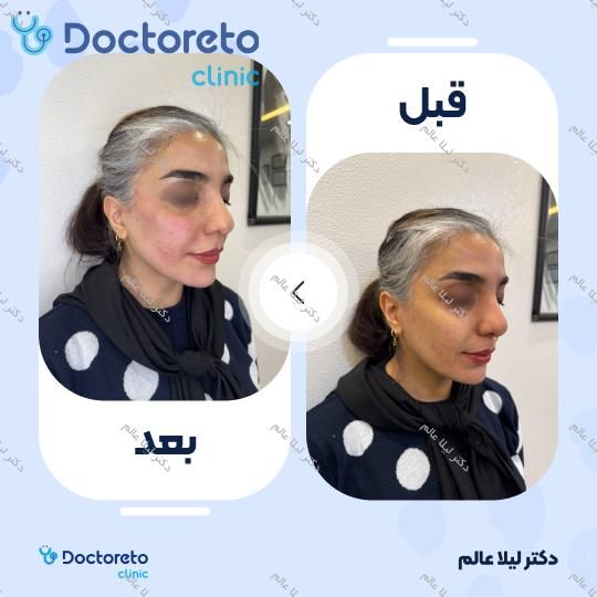 تزریق ژل گونه با برند رووفیل (1CC) دکتر لیلا عالم در اصفهان 3